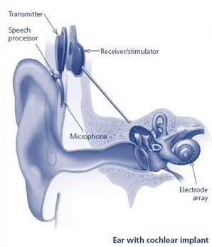 cochlear implant photo: cochlear implant 3775us8v.jpg